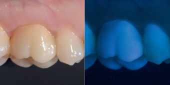Lateral view of the monolithic crown on the first molar
