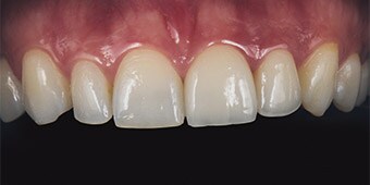 Treatment result with a veneer made of feldspathic ceramic
