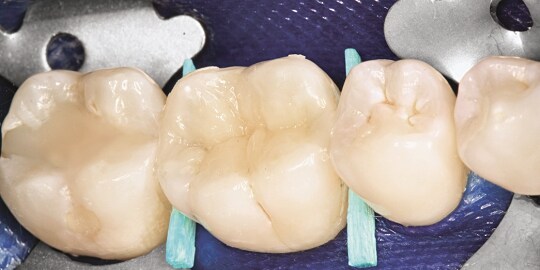 Clinical case bulkfill
