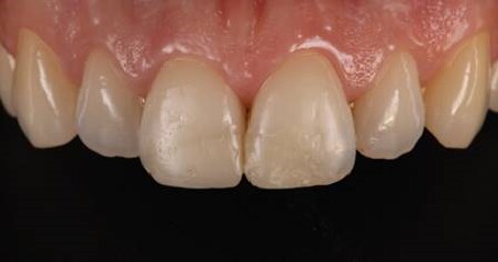 Image of esthetic replacement of anterior class IV restorations
