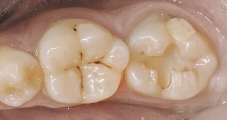 Image of esthetic replacement of two restorations on mandibular second molar
