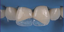 Image of esthetic restoration solution
